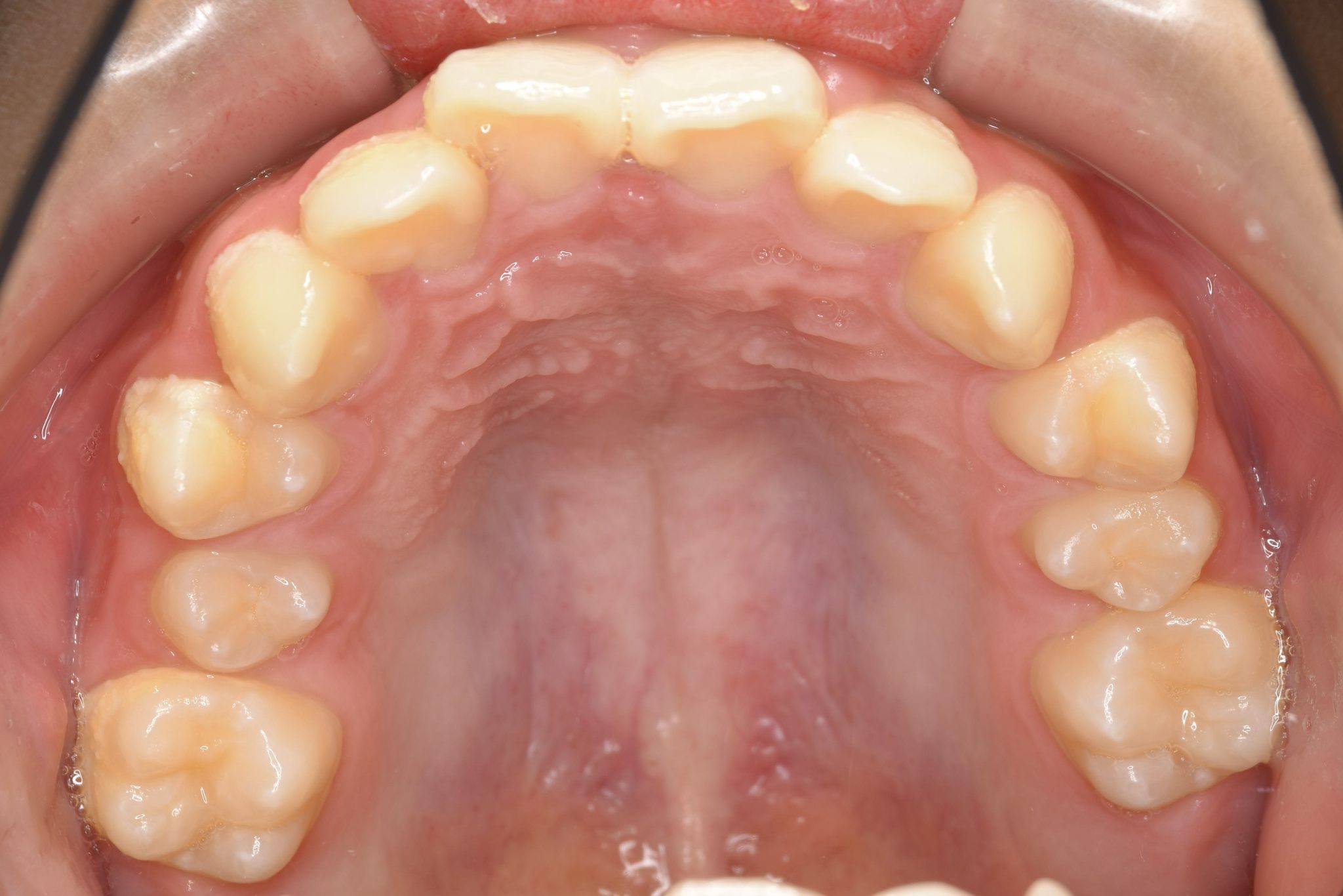 全顎ワイヤー矯正　症例_758