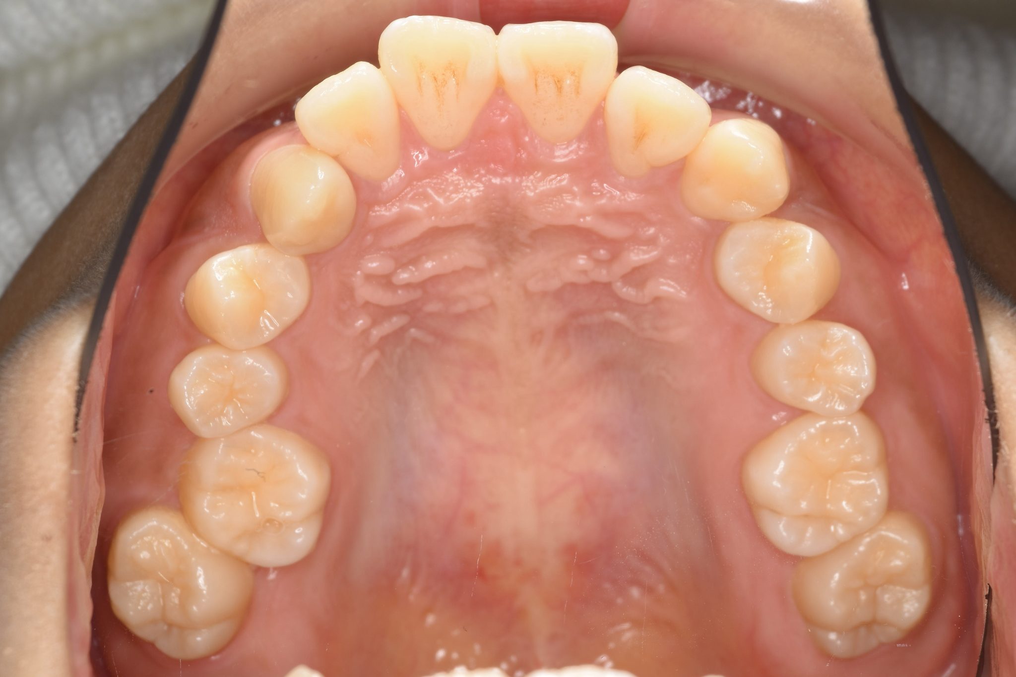 全顎ワイヤー矯正　症例_793