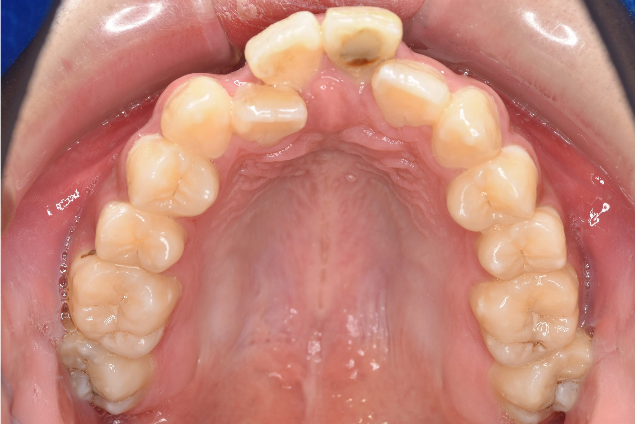 全顎ワイヤー矯正　症例_798
