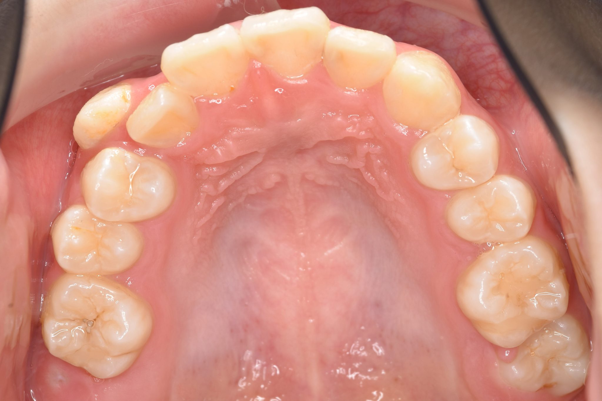 全顎ワイヤー矯正　症例_805