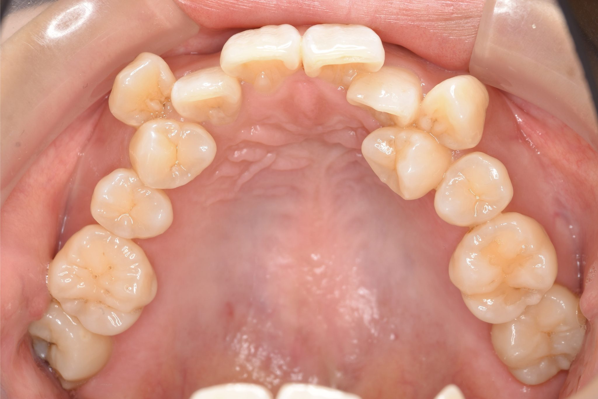 全顎ワイヤー矯正　症例_814