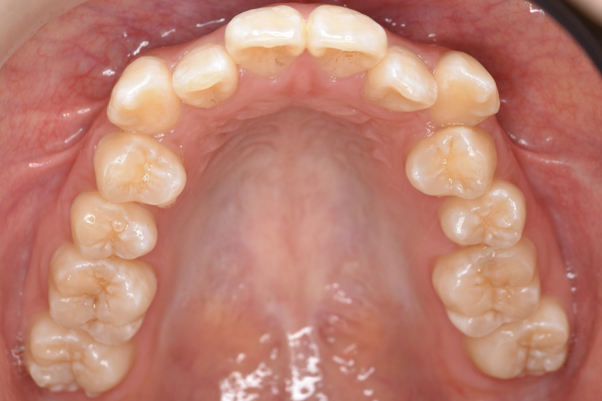 全顎ワイヤー矯正　症例_815