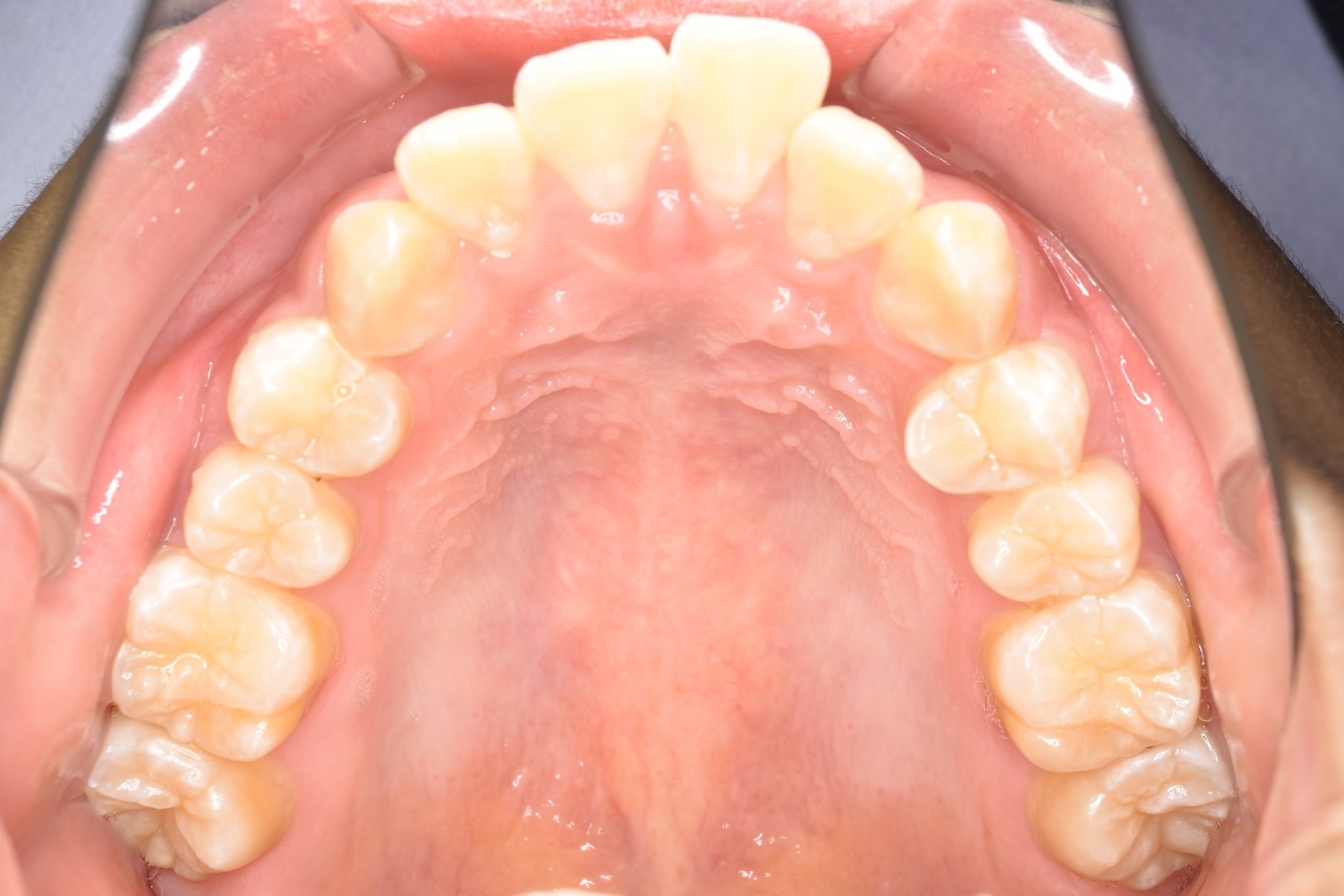全顎ワイヤー矯正　症例_252