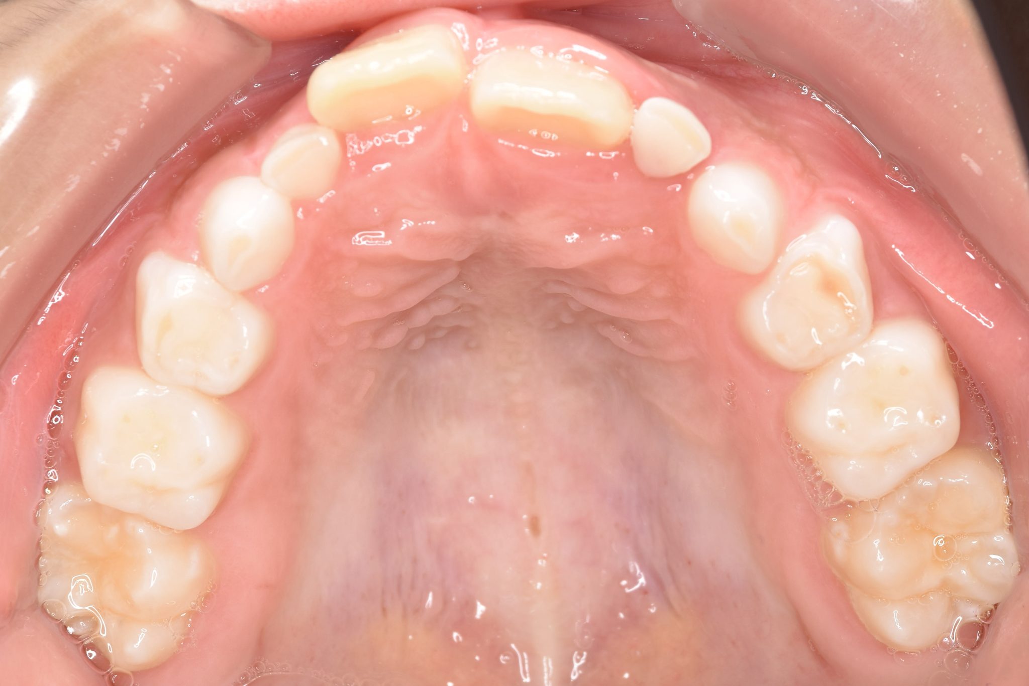 全顎ワイヤー矯正　症例_261