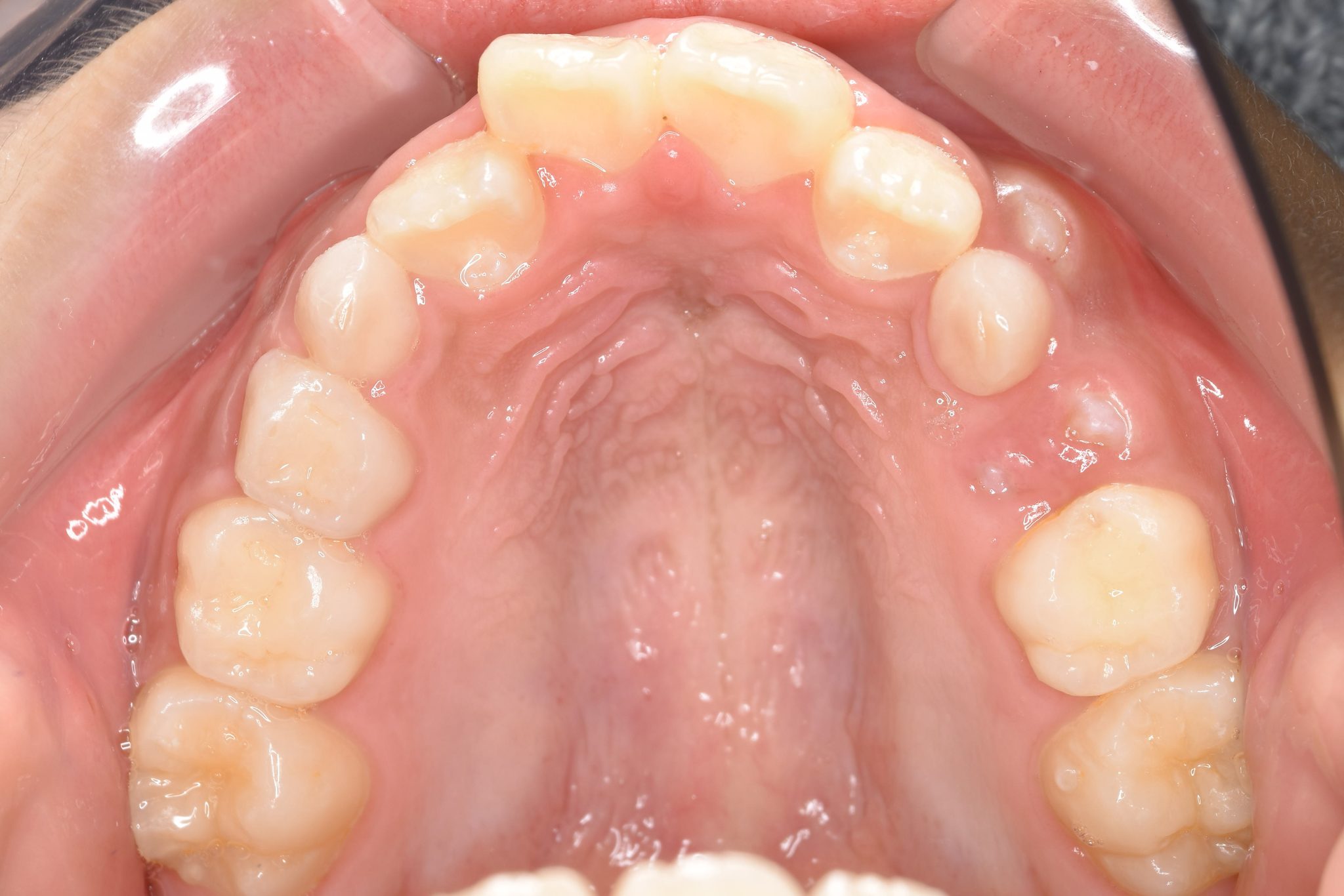 全顎ワイヤー矯正　症例_267