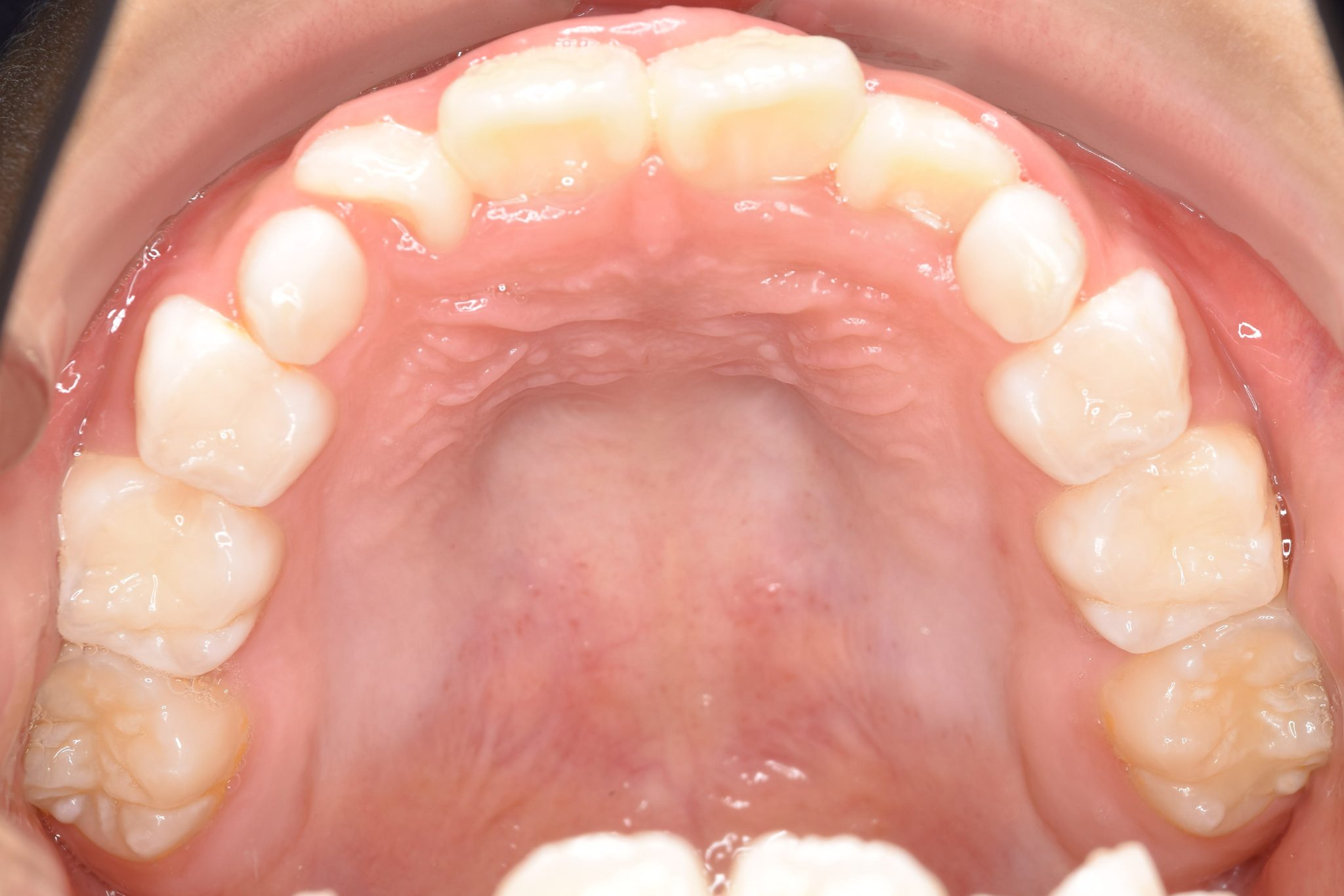 全顎ワイヤー矯正　症例_276