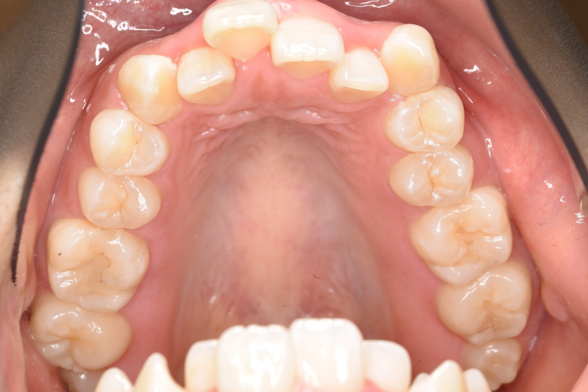 全顎ワイヤー矯正　症例_306