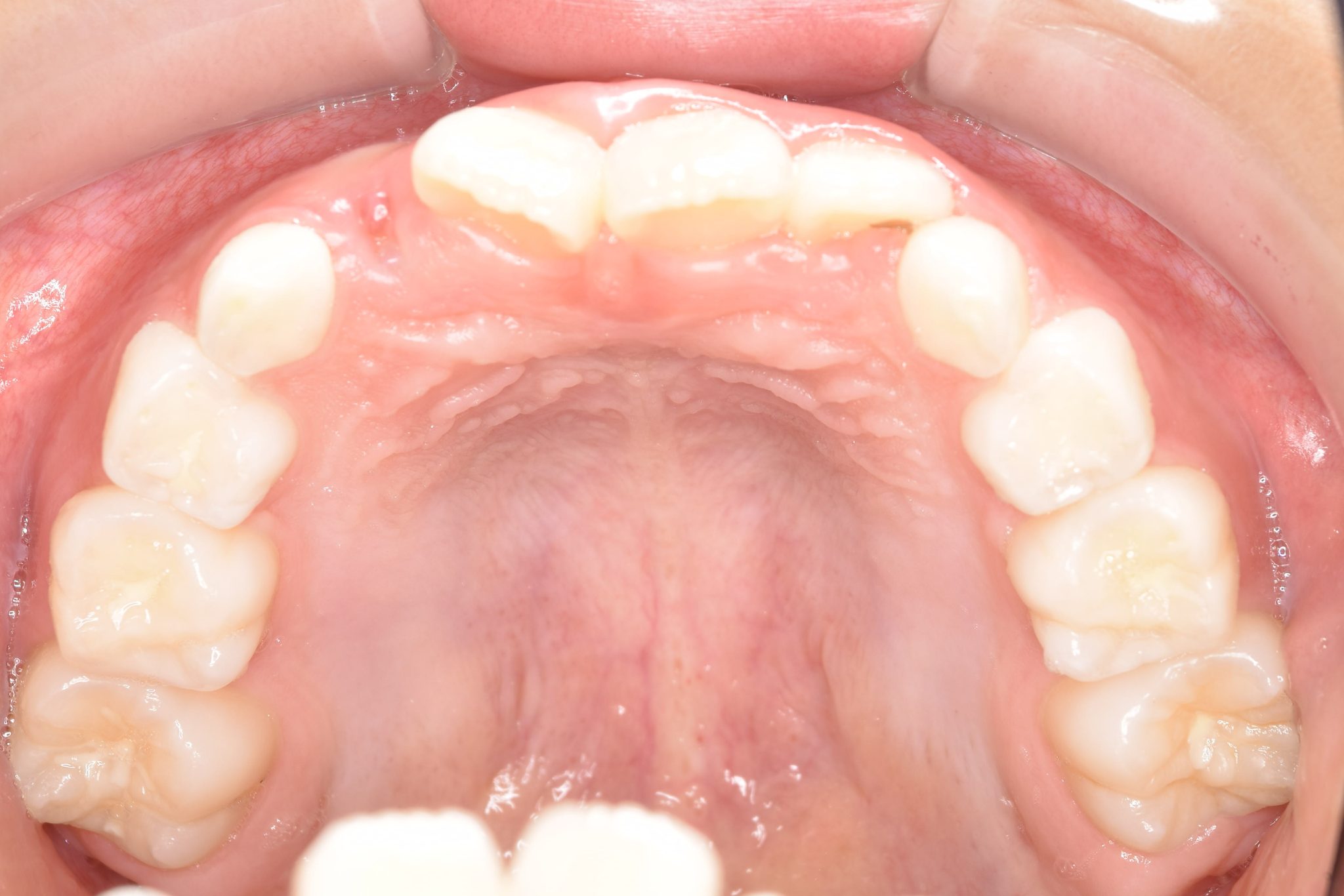 全顎ワイヤー矯正　症例_68