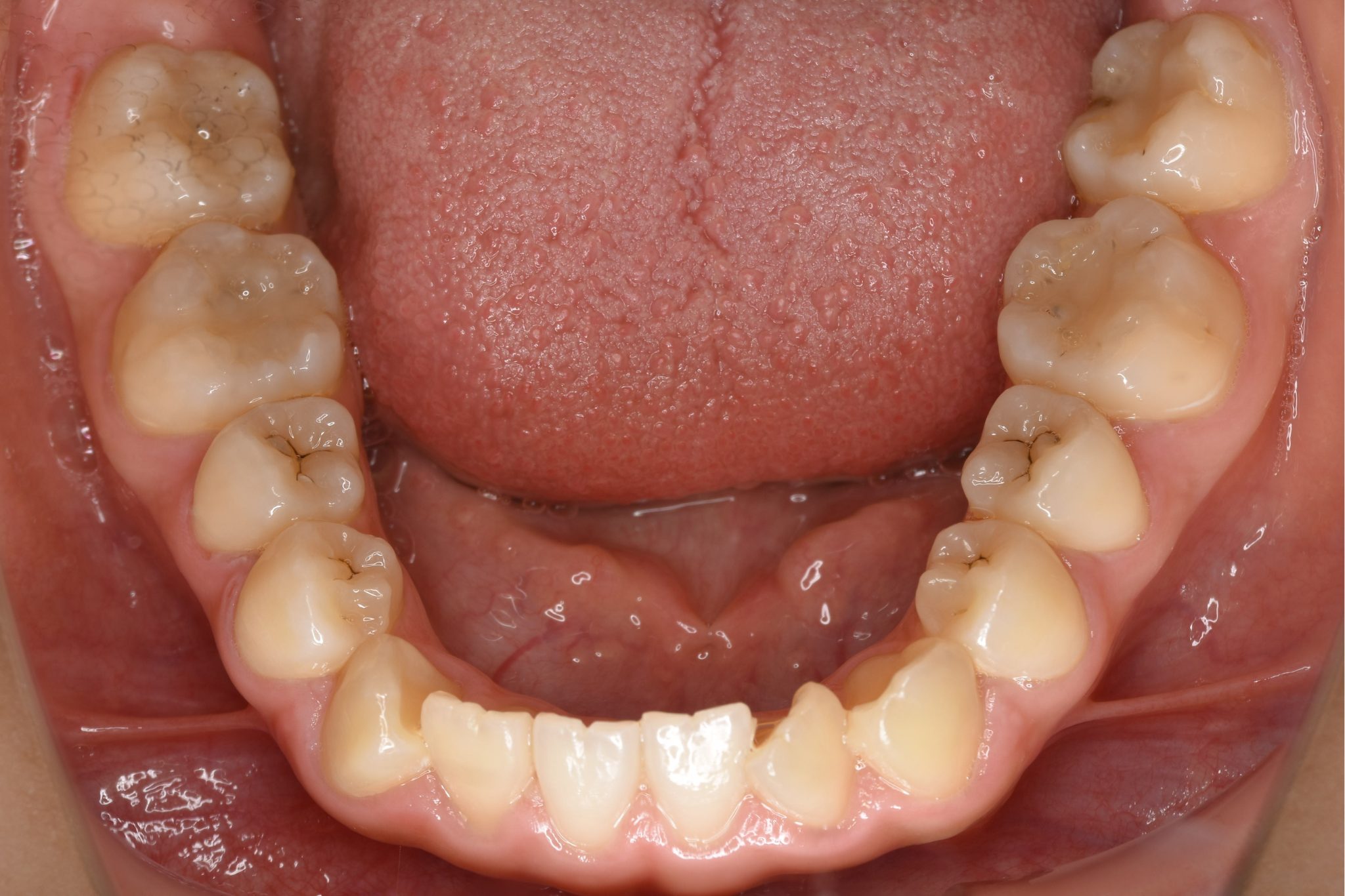 全顎ワイヤー矯正　症例_29